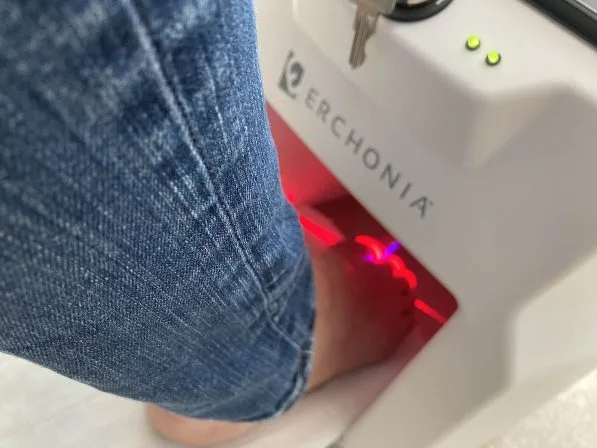 Lunula laser treatment in Canberra for fungal nail