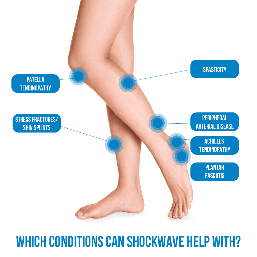 Shockwave Therapy Canberra