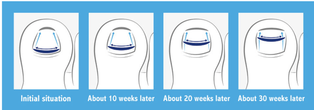 Diagram showing how the nail improves with Onyfix.