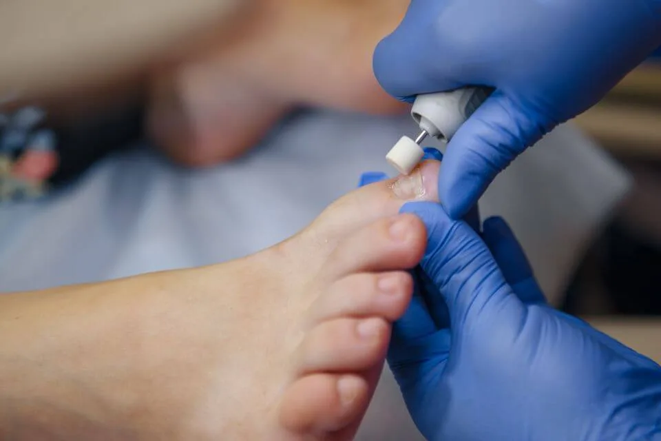 Fungal Nail Treatment Canberra