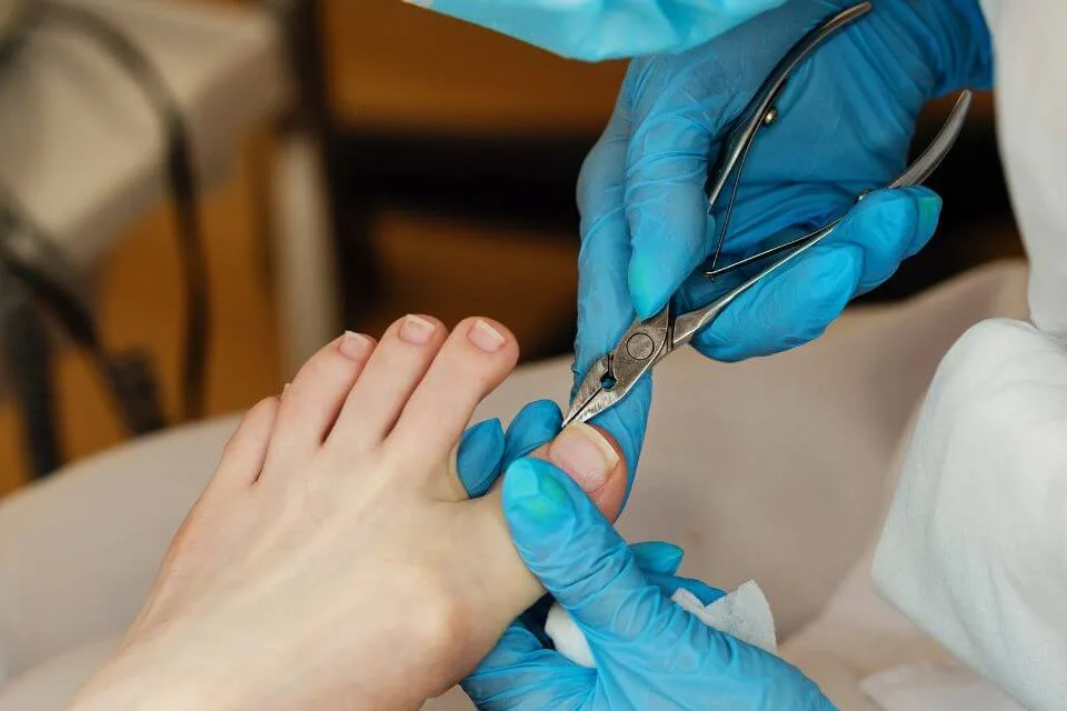 Fungal Toenail Treatment Canberra