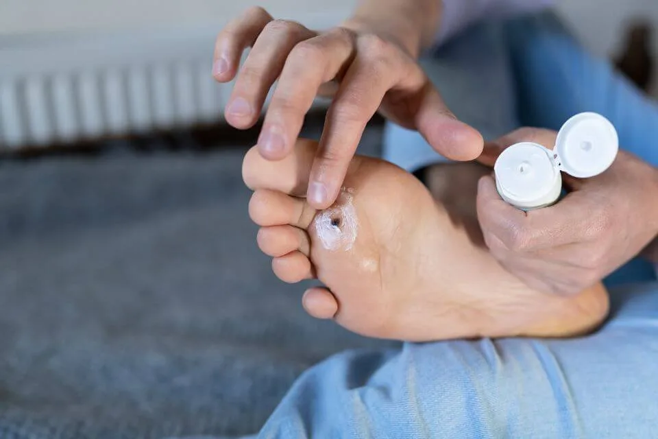Plantar wart treatment Canberra